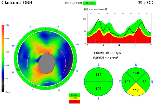 高機能OCT RTVue-100