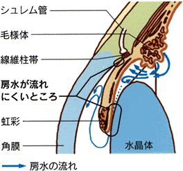 原発閉塞隅角緑内障